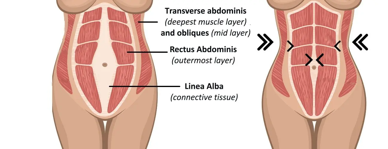 Diastasis Recti Causes Symptoms And Treatment Gulfphysio Uae S