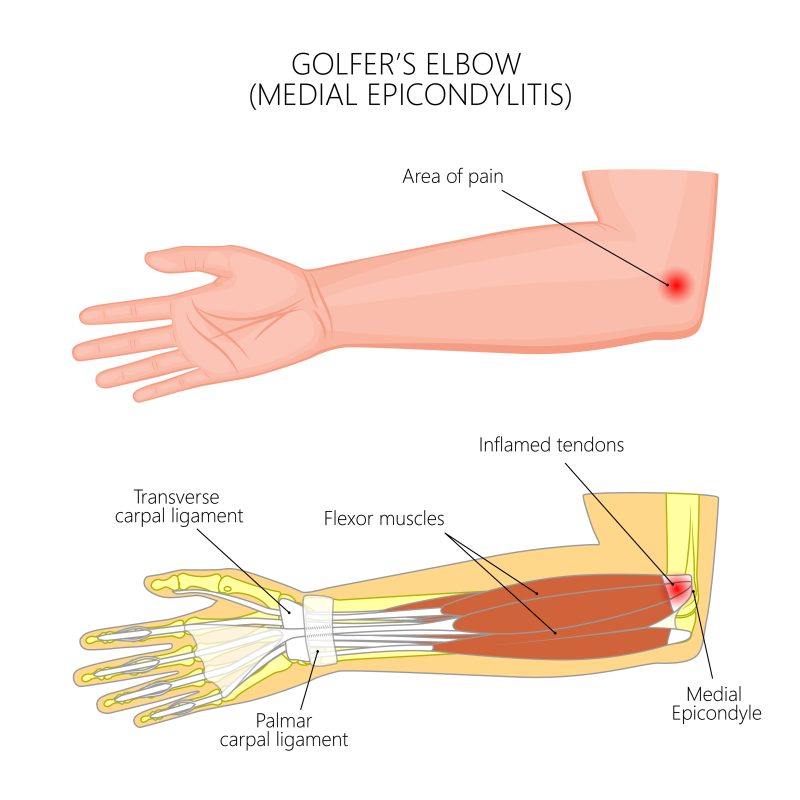 Elbow Injuries - GulfPhysio - UAE's Online Physiotherapy Store