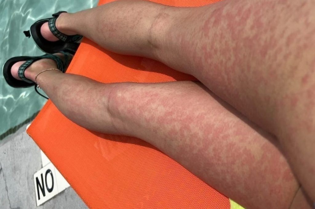 A person's legs are seen covered with swimmer's itch while laying down on an orange pool chair