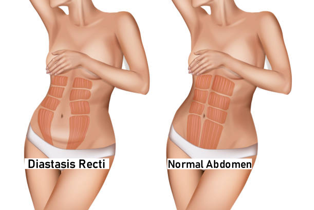 Abdominal Separation: Learn about Diastasis Recti and treatment