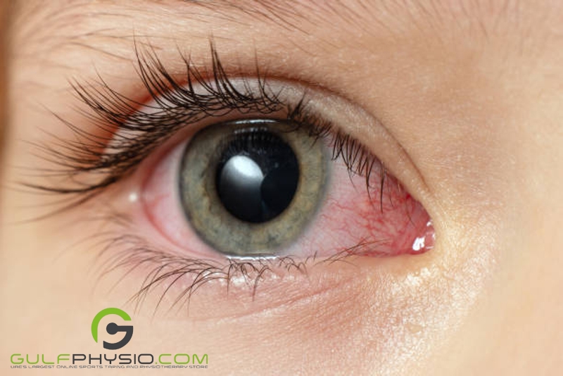 A close-up photo of an irritated eye. The sclera is visibly red instead of its normal white color.