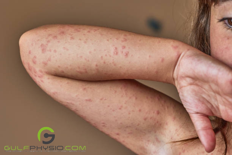 A close-up photo of a young girl's arm. The arm is covered in rashes.