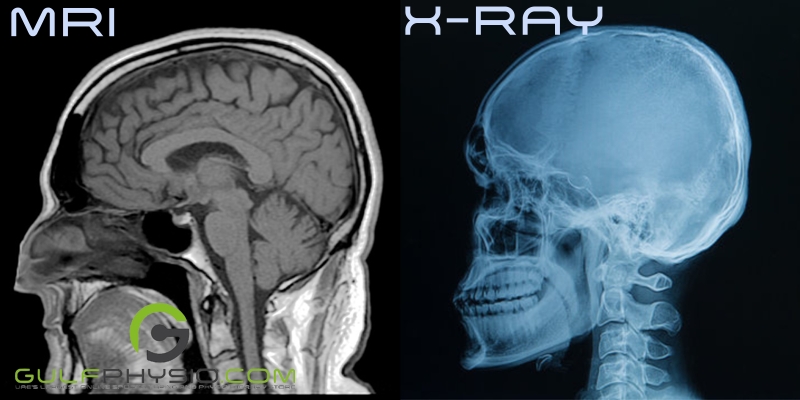  A comparison of the difference between an MRI scan versus an X-ray scan